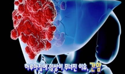 성인남자의 최대의 적 간암
