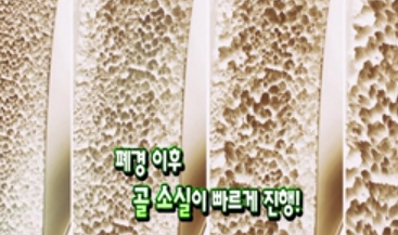 폐경기 증상과 골다공증의 치료