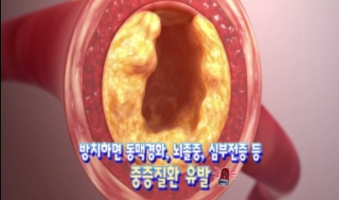 고혈압의 진단과 치료