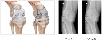 인공관절 사진3