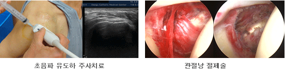 견관절질환 사진2