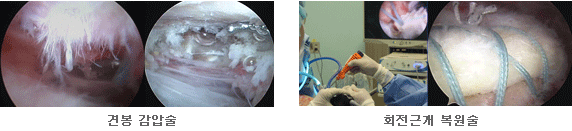 견관절질환 사진3