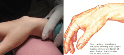 손목터널증후군 사진3